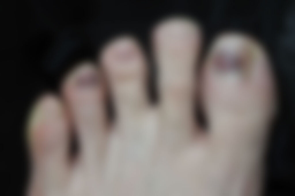 足の爪下血腫